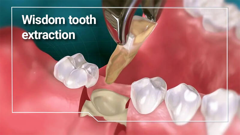 کشیدن دندان عقل؛ علل، خطرات و نکات جراحی آن