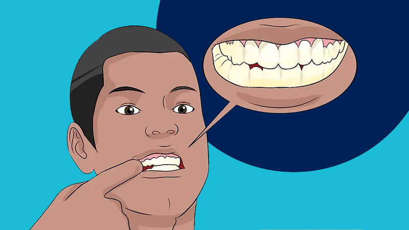 تقویت مینای دندان - علائم فرسایش مینای دندان را بشناسید.