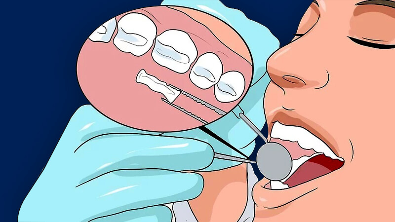 تقویت مینای دندان - نواحی فرسوده را با فیلینگ‌ها بازیابی کنید.