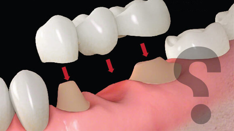 آیا بریج‌های دندان خطرات و عوارضی دارند؟ - بریج دندان