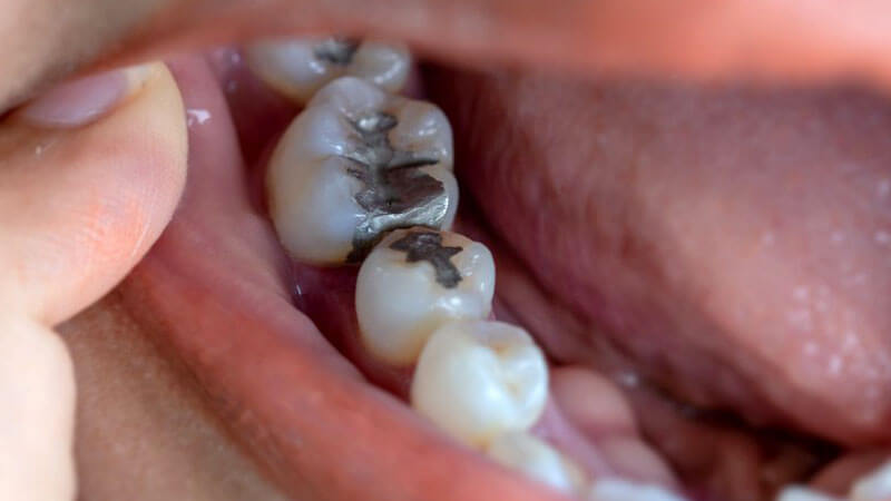 اگر نگران جیوه در آمالگام دندانی هستیم، آیا باید پرکردگی ها را خارج کنیم؟ - آمالگام چیست
