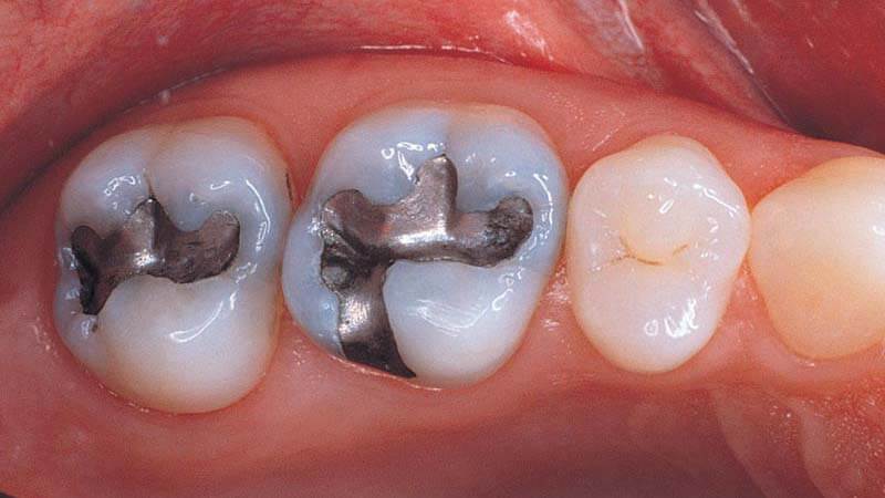 آمالگام دندانی چیست؟ - آمالگام چیست