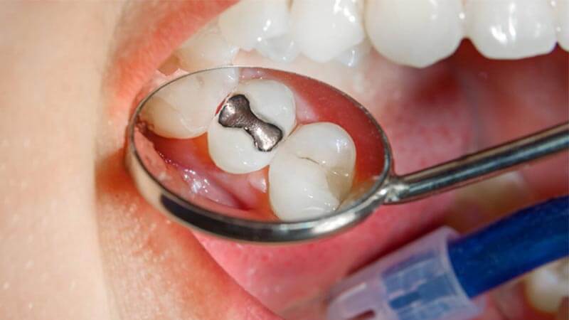 چرا از جیوه در آمالگام دندانی استفاده می شود؟ - آمالگام چیست