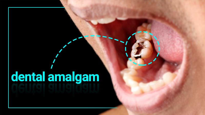 آمالگام چیست؛ مزایا، معایب و ویژگی‌های آمالگام دندانی