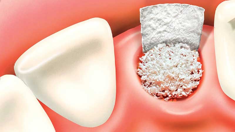 بهبود و مراقبت‌های بعدی برای پیوند استخوان دندان چگونه است؟