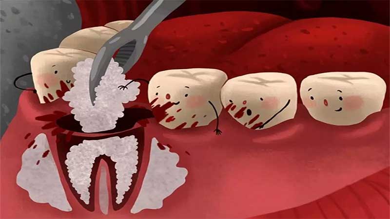 عوارض پیوند استخوان دندان چیست؟