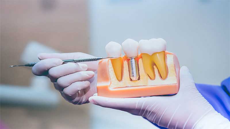 7 نکته برای مراقبت از ایمپلنت‌های دندان خود - مراقبت از ایمپلنت دندان