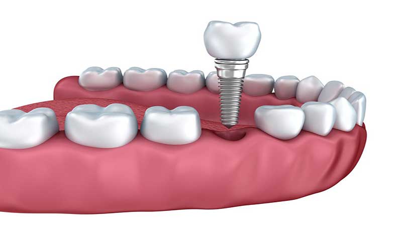 آیا می‌توان ایمپلنت دندانِ عفونت کرده را بهبود بخشید؟