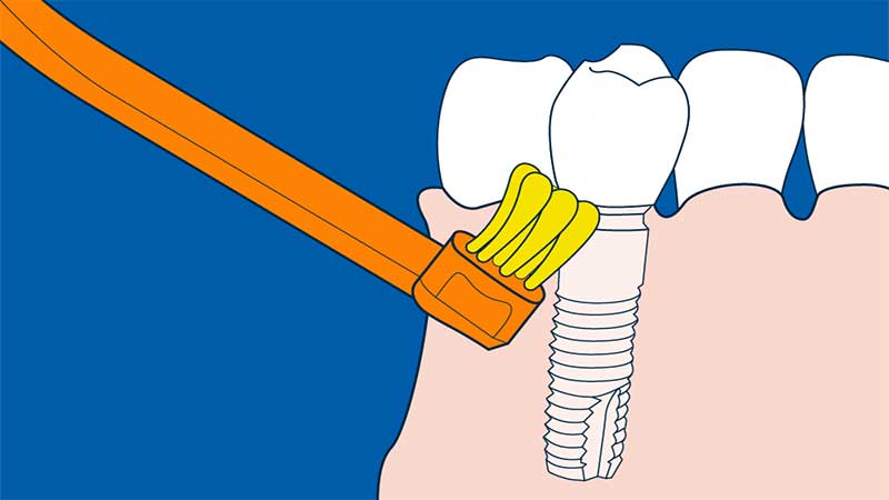 مسواکِ تمیز کننده‌ی ایمپلنت دندان - مسواک مخصوص ایمپلنت