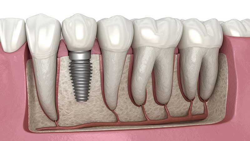 کاشت دندان چیست؟