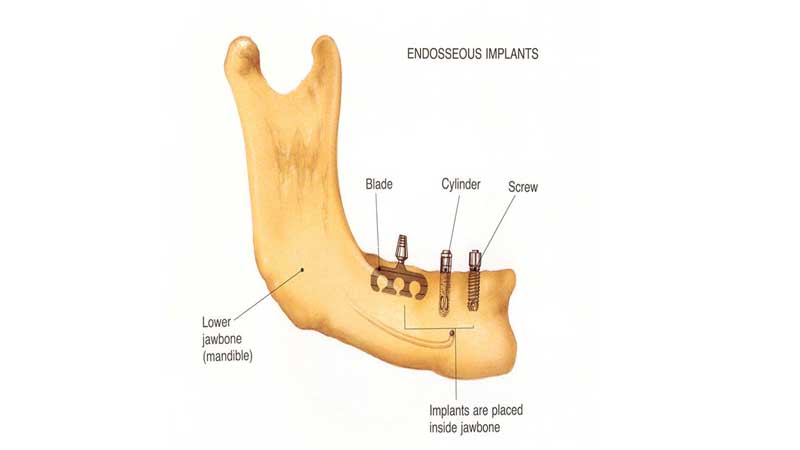 ایمپلنت‌ اندوستیال دندان چیست؟