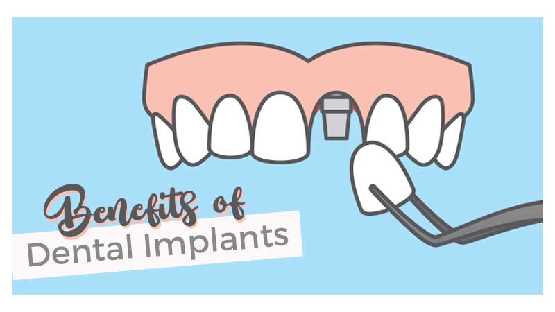 فواید ایمپلنت - انتقال از دندان مصنوعی به ایمپلنت