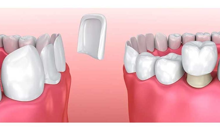 تفاوت کامپوزیت و لمینت دندان؛ کدام یک بهتر است؟