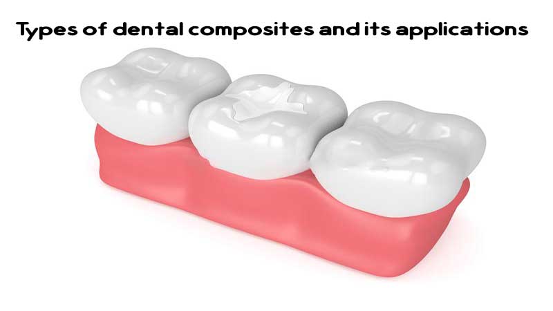 انواع کامپوزیت دندان و کاربردهای آن