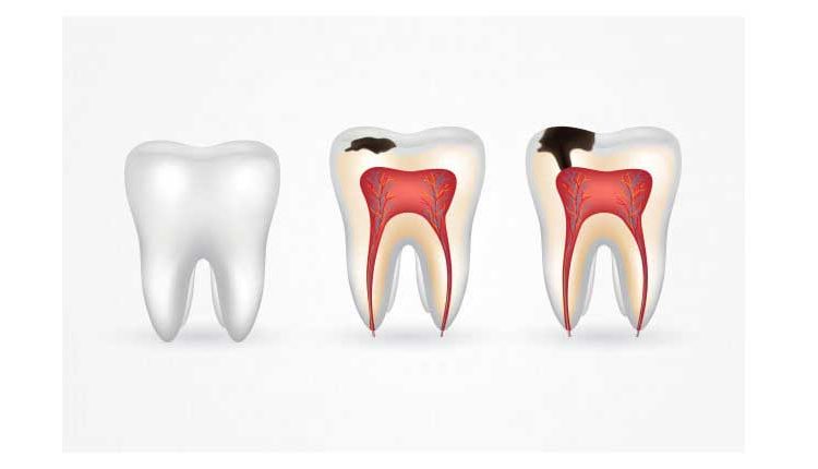 طول عمر کامپوزیت دندان و عوامل تأثیرگذار بر آن