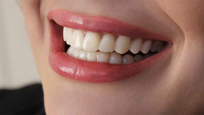 آیا لمینت برای سلامتی دندان مضر است؟ - عوارض لمینت دندان