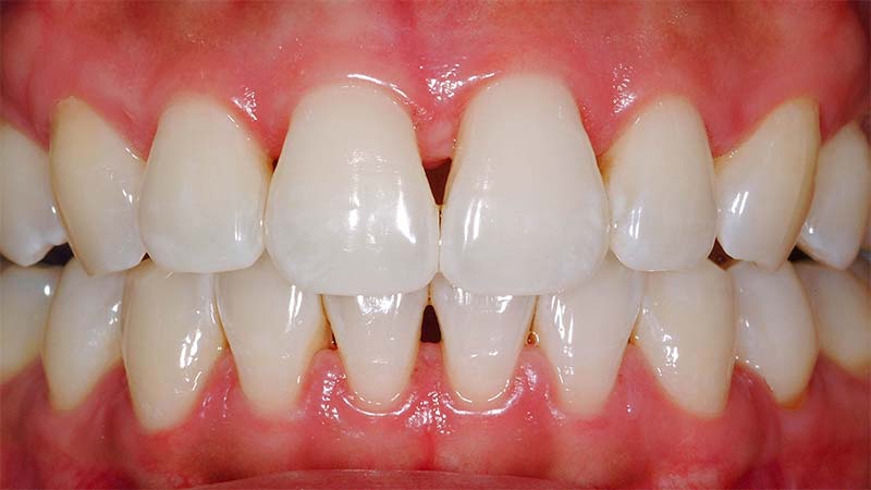 بررسی کردن کامپوزیت دندان به هنگام گاز گرفتن - مراحل کامپوزیت دندان