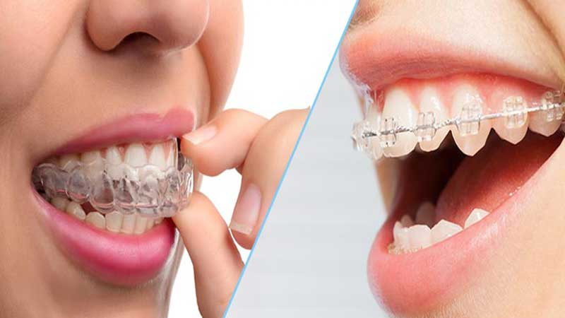 حرکت دندان با دستگاه ارتودنسی متحرک