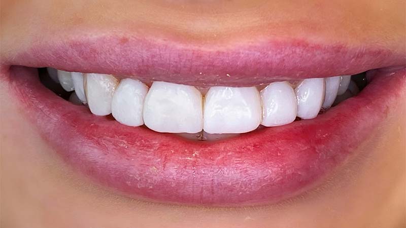 دلایل استفاده از کامپوزیت دندان