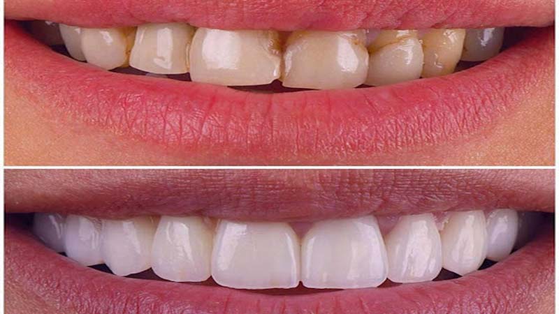 راه‌حل بروز مشکل پس از لمینت دندان - عوارض لمینت دندان