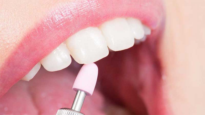پولیش نهایی - مراحل کامپوزیت دندان