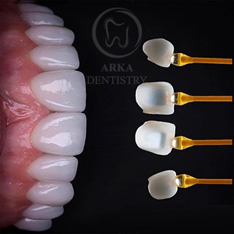 کلینیک دندانپزشکی آرکا - لمینیت۶
