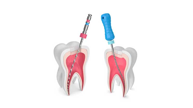 کانال ریشه چیست؟ | کلینیک دندانپزشکی آرکا