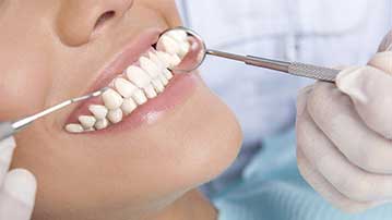 Types of dental laminates based on components