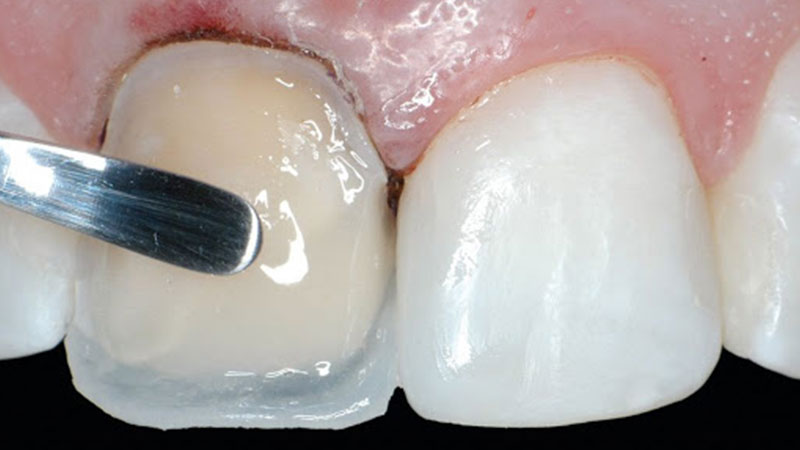 انواع کامپوزیت دندان و مزیت‌های آن