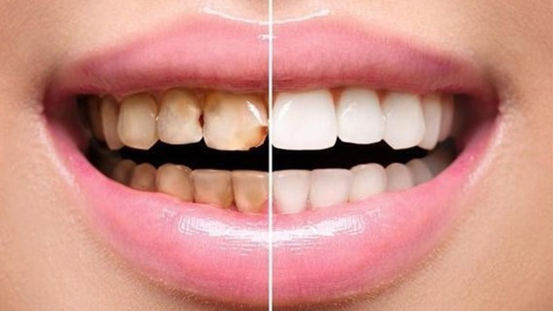 تفاوت لمینت و کامپوزیت دندان