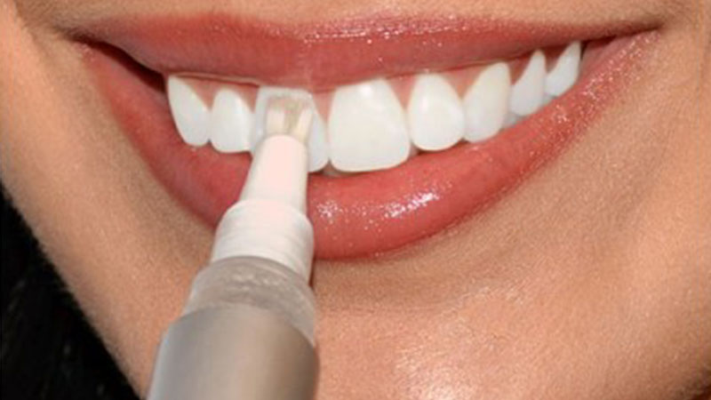 دلایل منع استفاده از لاک سفید کننده دندان