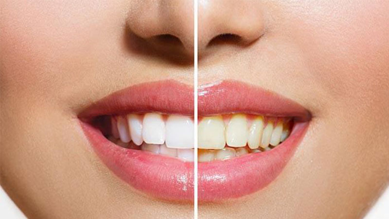 علت تغییر رنگ دندان - لاک سفید کننده دندان