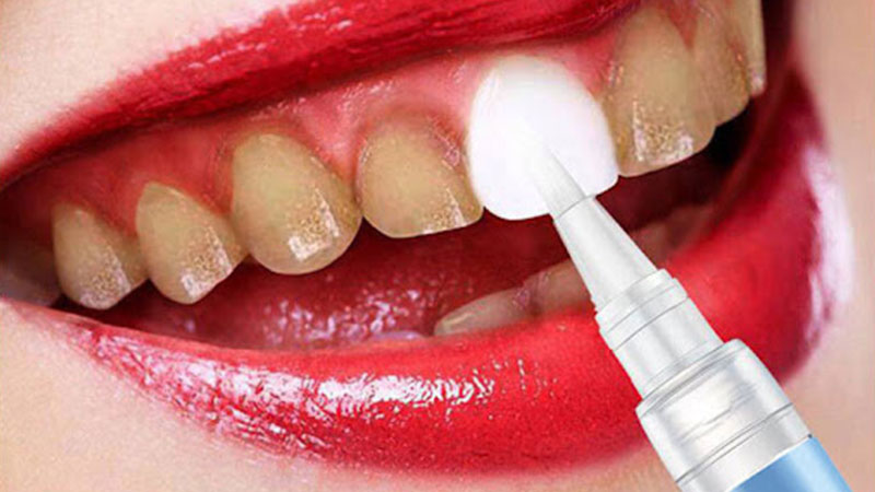 فواید استفاده از لاک سفید کننده دندان