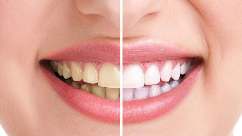 لمینت بهتر است یا کامپوزیت؟ - تفاوت لمینت و کامپوزیت دندان