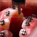 کلینیک-دندانپزشکی-آرکا-گالری-ارتودنسی-دندان