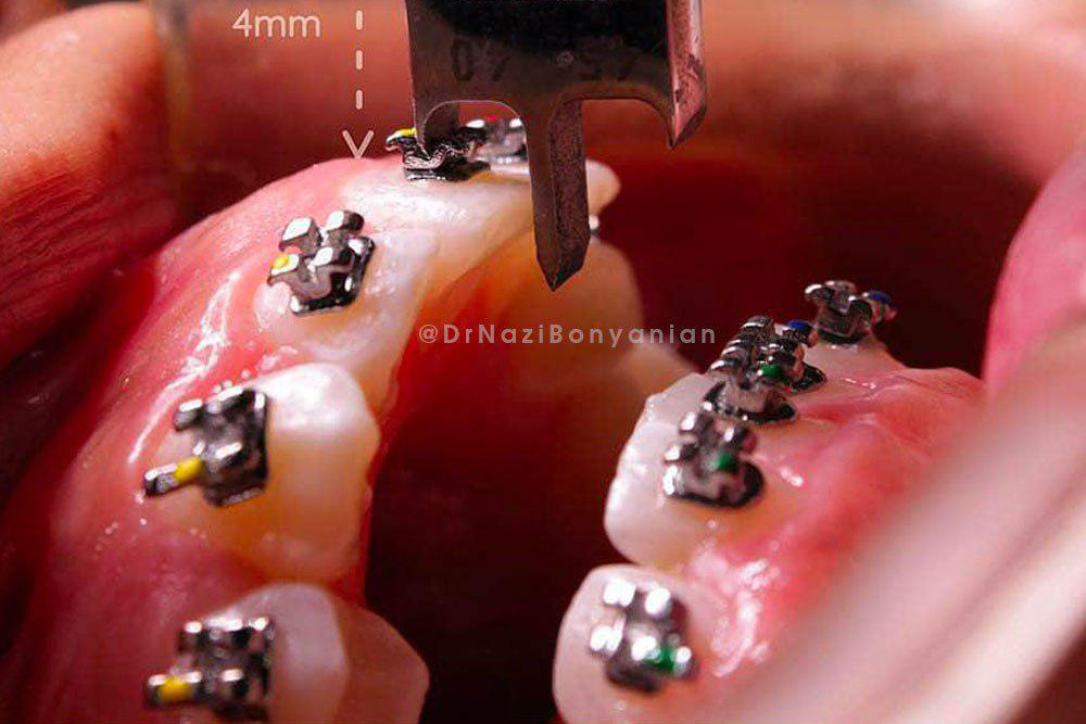 کلینیک-دندانپزشکی-آرکا-گالری-ارتودنسی-دندان