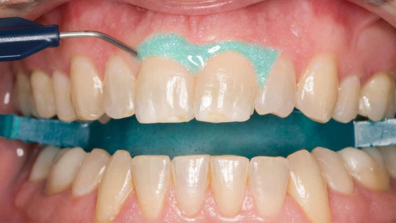 آیا عوارض احتمالی بلیچینگ دندان طولانی مدت است؟ - عوارض بلیچینگ دندان