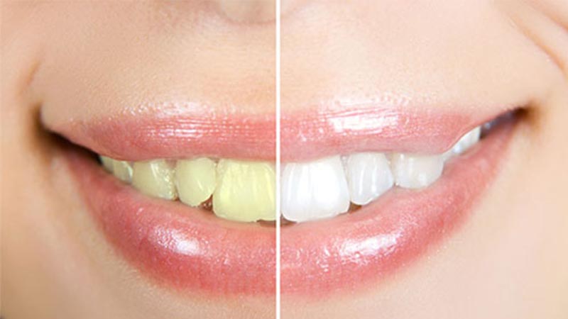 آیا لومینیرز بدون تراشیدن دندان ممکن است؟ - لومینیرز دندان