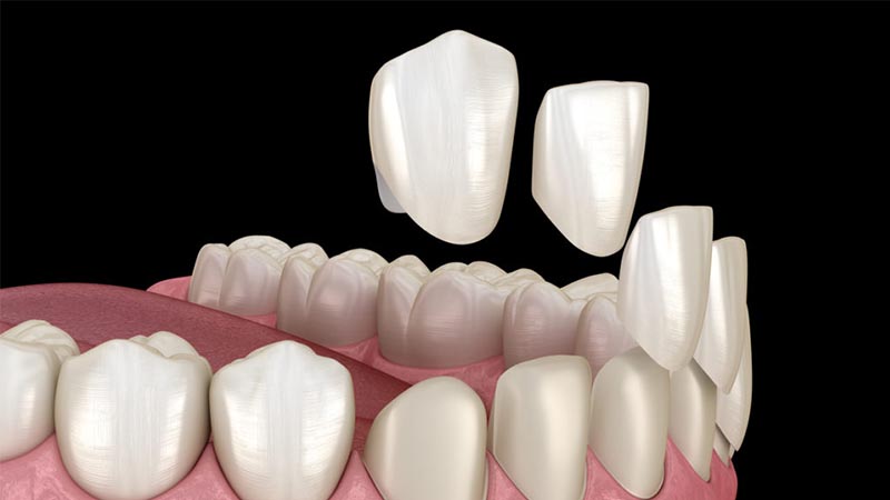 تفاوت اجرای لومینیرز و لمینت دندان - لومینیرز دندان