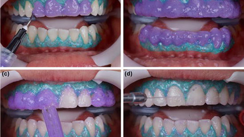 تفاوت روش های بلیچینگ دندان
