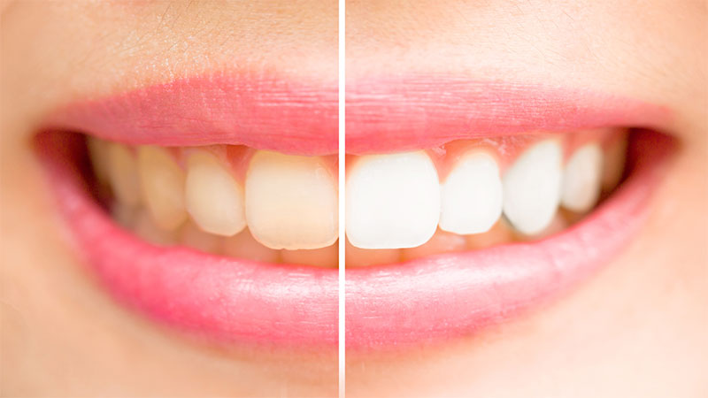 حفظ سفیدی دندان‌ها پس از بلیچینگ - بلیچینگ در خانه