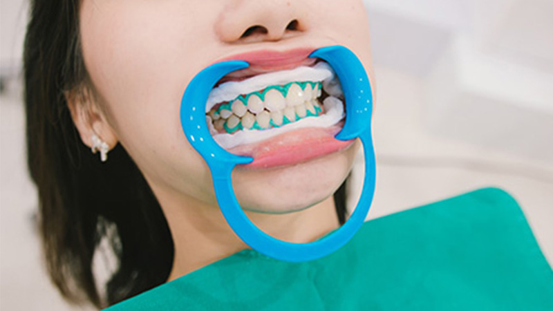 راهکارهای به حداقل رساندن عوارض بلیچینگ - عوارض بلیچینگ دندان