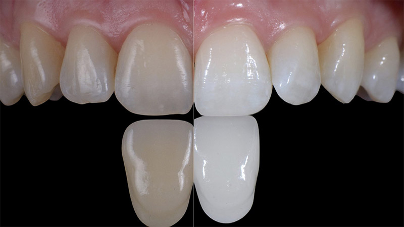 روش‌های کلی بلیچینگ دندان