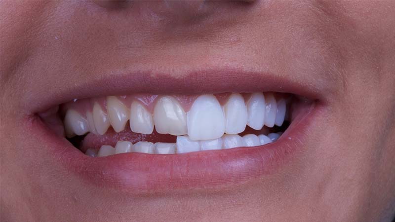 عارضه‌هایی که می‌توانند با استفاده از لومینیرز بهبود یابند - لومینیرز دندان