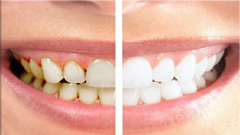 مزایای لومینیرز دندان نسبت به ونیر کامپوزیت