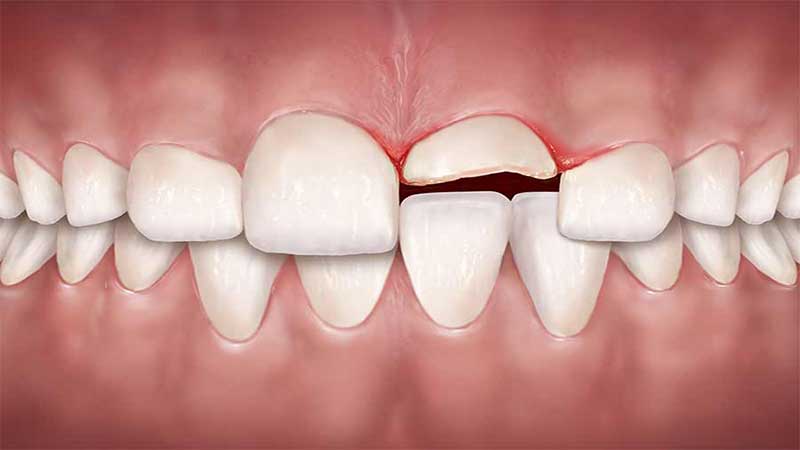 آسیب های ناشی از تروما به دندان