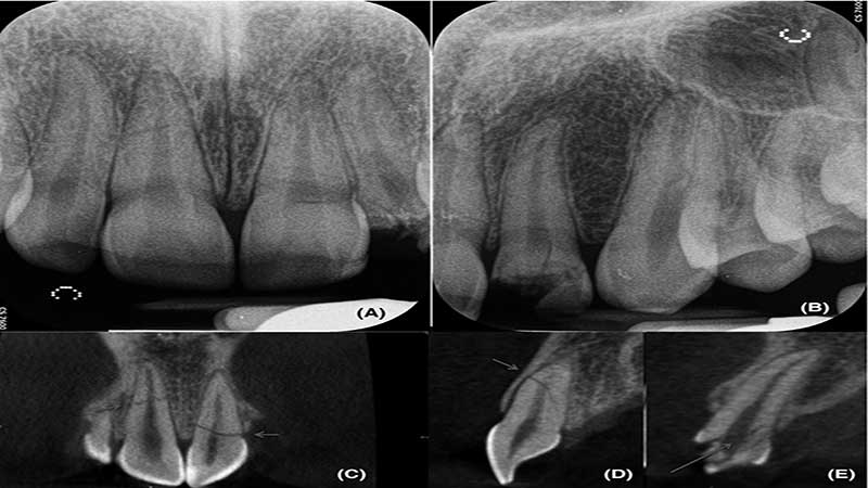 رادیوگرافی بعد از ترومای دندان