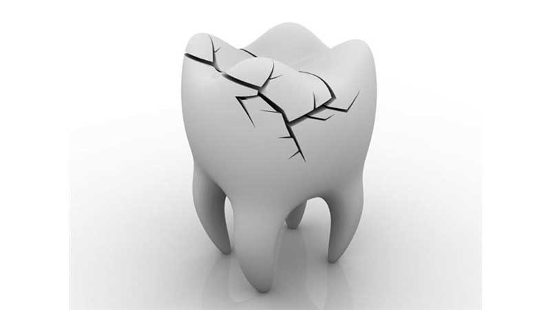 رایج‌ترین انواع ترومای دندان - تروما چیست