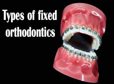 Types of fixed orthodontics