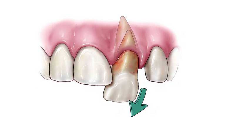 تروما چیست؛ تروما دندان چگونه به وجود می‌آید